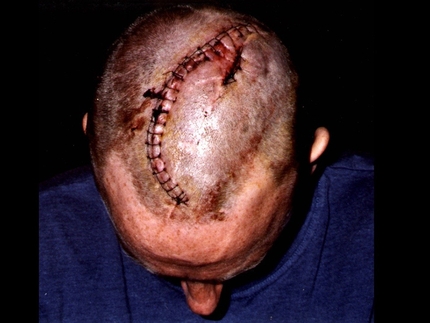 Paul Pritchard, Totem Pole, Tasmania - La cicatrice di Paul Pritchard dopo il terribile incidente sul Totem Pole in Tasmania nel 1998