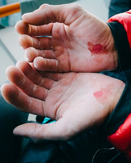 Barbara Zangerl  - The hands of Jacopo Larcher after an attempt on the Stemming Corner Pitch on the Pre-Muir Wall up El Capitan in Yosemite