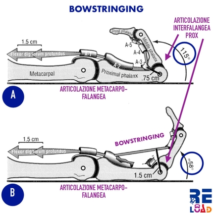Arrampicata, infortuni, prevenzione - Effetto bowstringing: posizione del tendine prima e dopo la rottura delle pulegge A2 e A3 nell'arrampicata