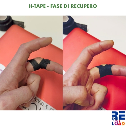 Arrampicata, infortuni, prevenzione - Arrampicata nastro: H-Tape nastratura dopo rottura puleggia A3: fase di recupero